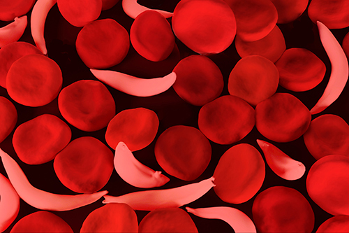 Sickle cell anemia